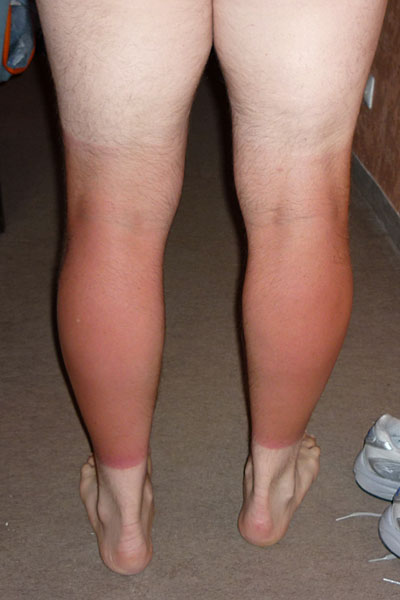 Von der Sonne "verwöhnt"